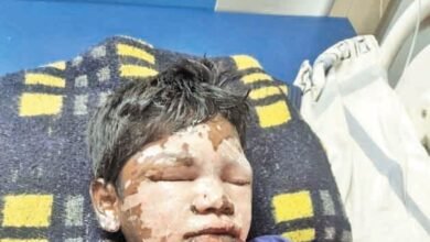 छात्रावास में नाबालिग छात्र खुद बना रहा था भोजन, खौलते तेल से बुरी तरह झुलसा