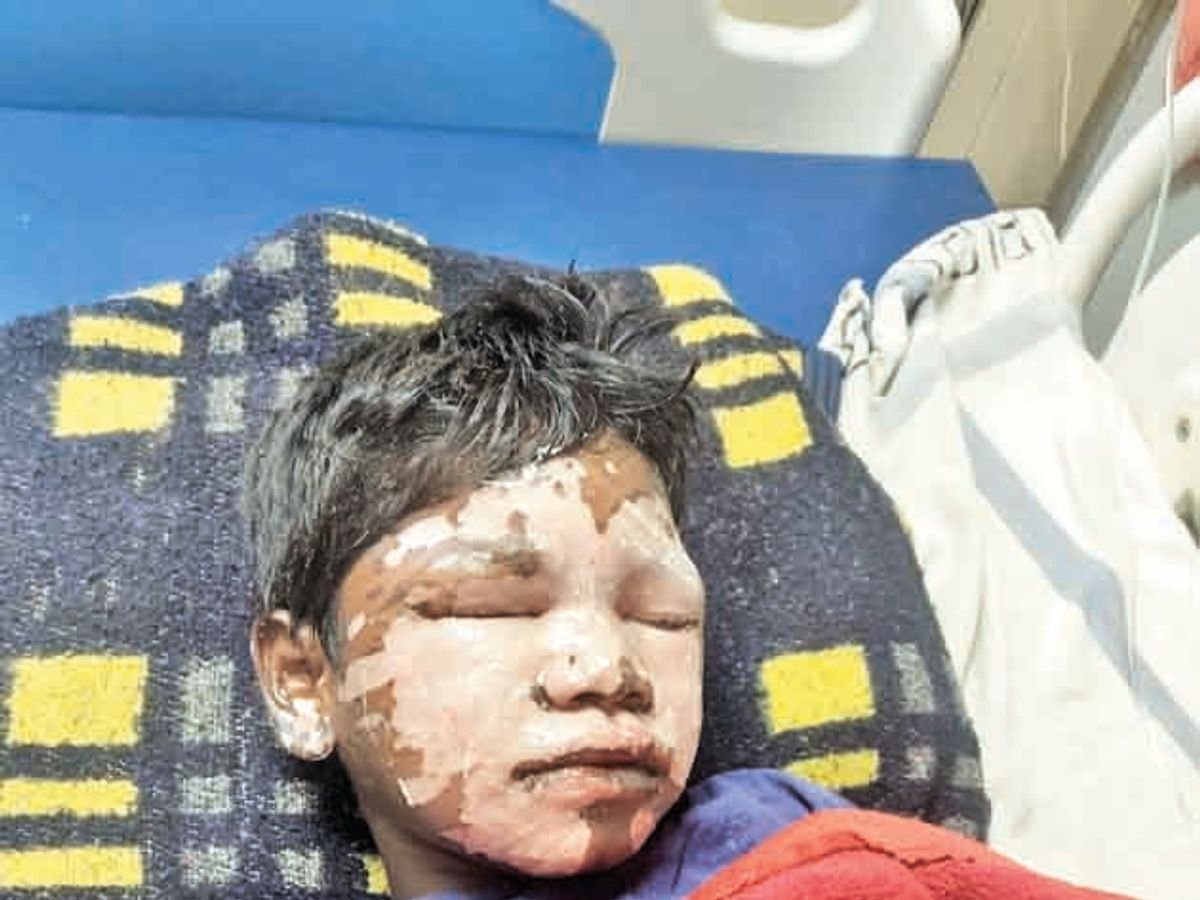 छात्रावास में नाबालिग छात्र खुद बना रहा था भोजन, खौलते तेल से बुरी तरह झुलसा