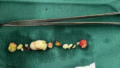 भोपाल के अस्पताल में दुर्लभ सर्जरी, महिला के पैन्क्रियाज से निकाले गए 15 से अधिक स्टोन