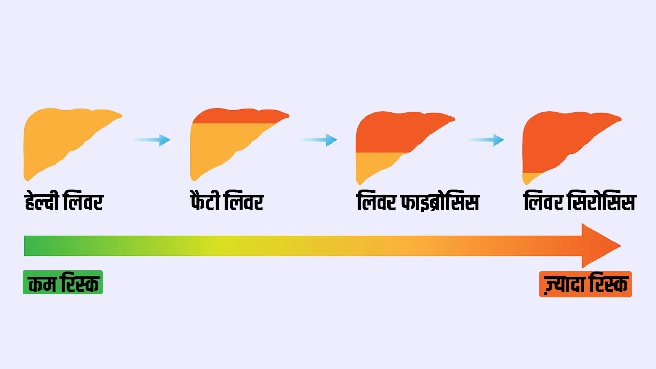 अल्ट्रासाउंड में फैटी लिवर ग्रेड-2 आने का क्या मतलब, ये कितना ख़तरनाक है?