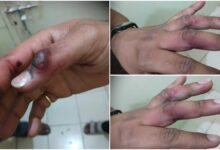 जेब में रखे मोबाइल के फटने से झुलसा छात्र, इस कंपनी का था मोबाइल…