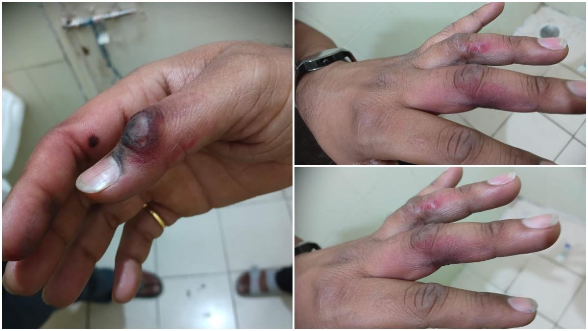 जेब में रखे मोबाइल के फटने से झुलसा छात्र, इस कंपनी का था मोबाइल…