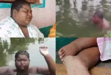 बीमार भी, लाचार भी….सालों से खुद को तालाब में डुबोए है किशोर, जलन का नहीं मिला इलाज