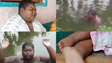 बीमार भी, लाचार भी….सालों से खुद को तालाब में डुबोए है किशोर, जलन का नहीं मिला इलाज